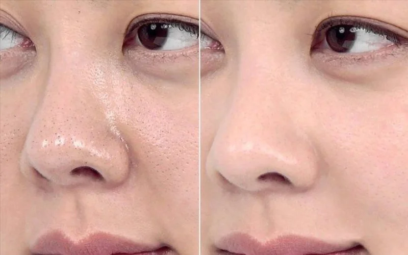 skin tightening